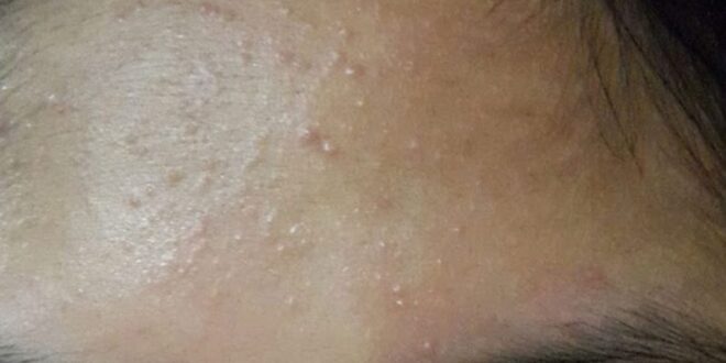 cara mengatasi kulit berminyak dan kusam dengan bahan alami_768977adc.jpg