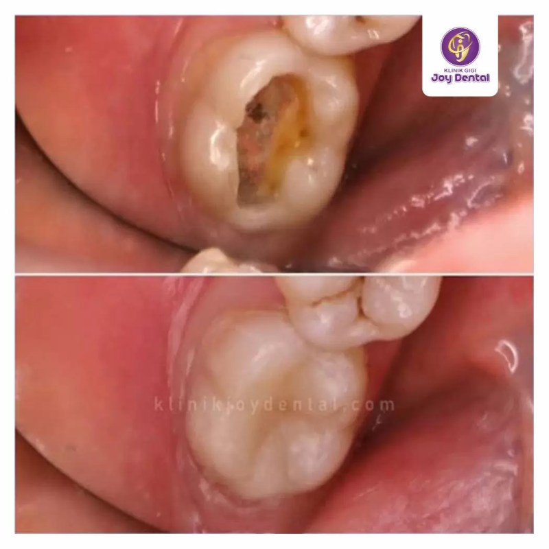 Gigi Geraham Atas Sakit Tapi Tidak Berlubang - HOBINGEBLOG.COM