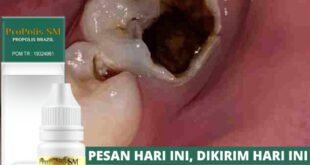 cara mengobati gigi berlubang agar tidak kambuh lagi_ef2eefd3d.jpg