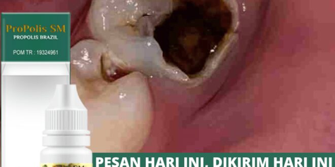 cara mengobati gigi berlubang agar tidak kambuh lagi_ef2eefd3d.jpg